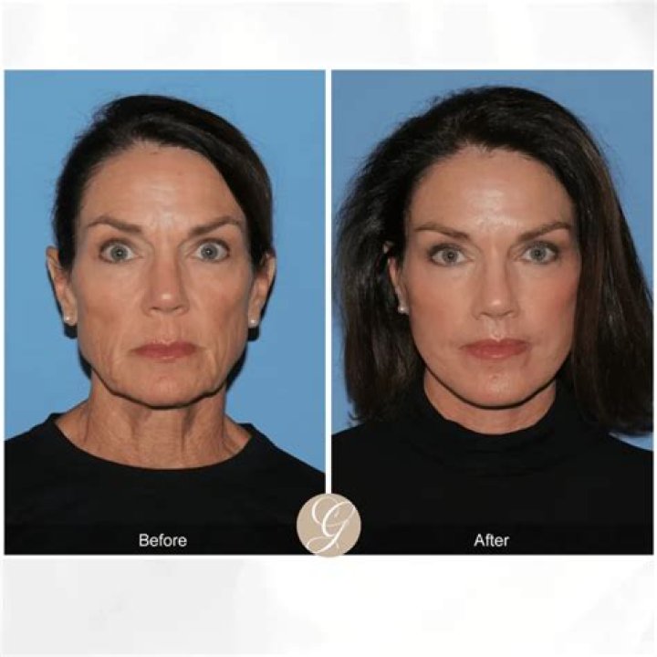 Has Chris Rock had A facelift with botox and a nose job? Everything you need to know