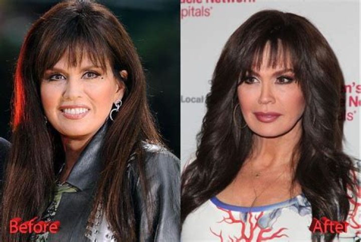Marie Osmond Without Makeup Look: Plastic Surgery Before And After