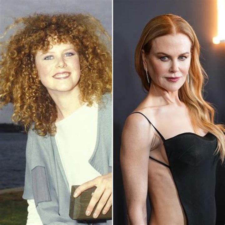 Nicole Kidman Facelift | Plastic Surgery Before And After