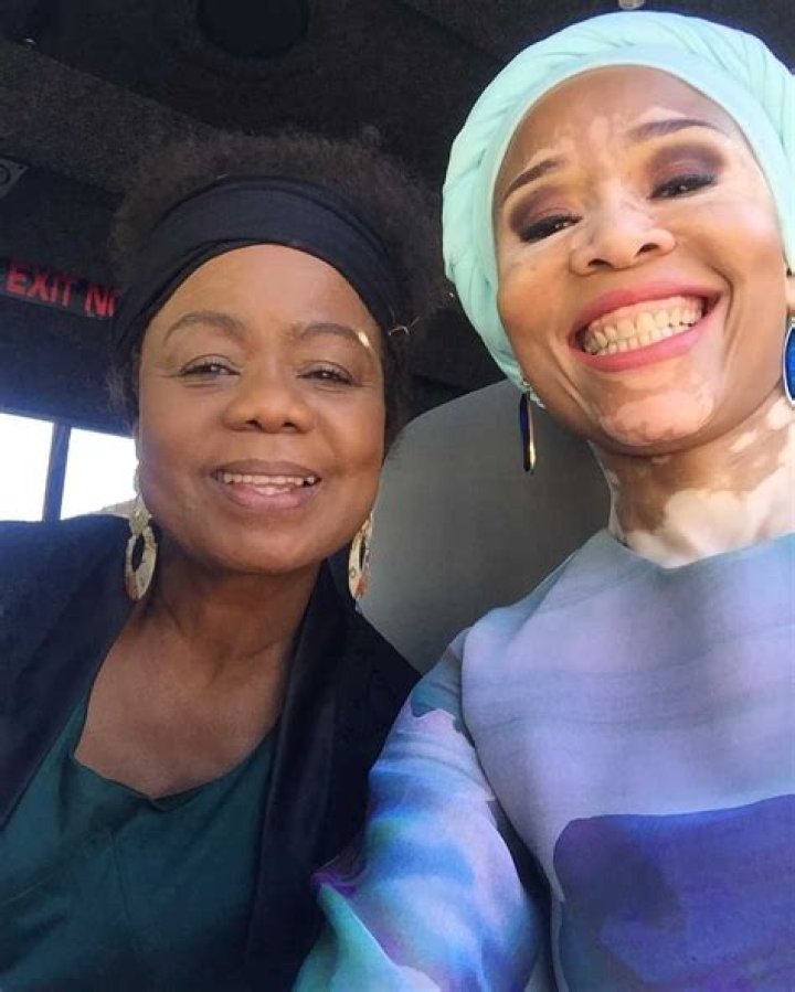
Sarafina Real? Leleti Khumalo’s Skin: What Happened? 