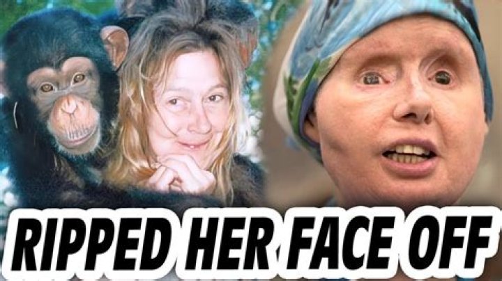 What Happened To Charla Nash? Woman Had To Undergo Face Transplant Surgery After Chimp Attack